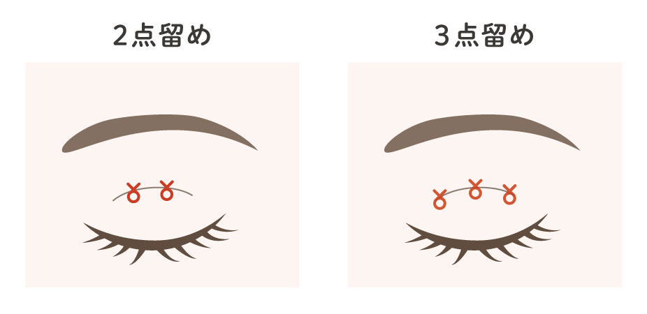 埋没法の2点留めと3点留めの違い