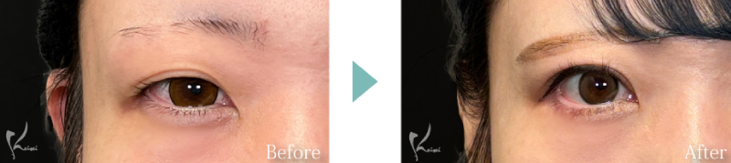 口唇縮小術のBeforeとAfter