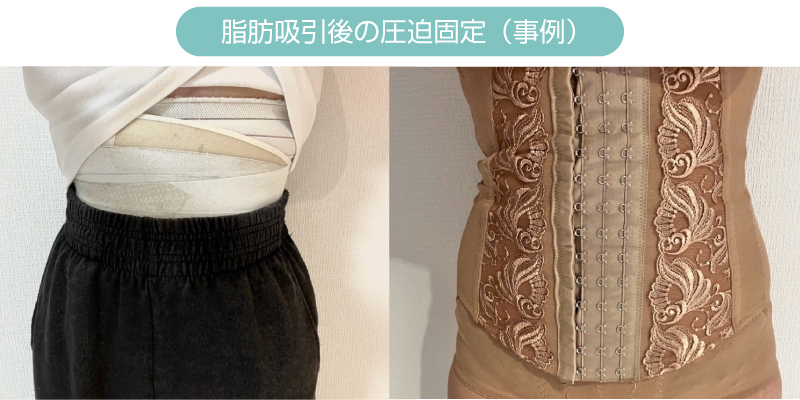 脂肪吸引後の圧迫イメージ