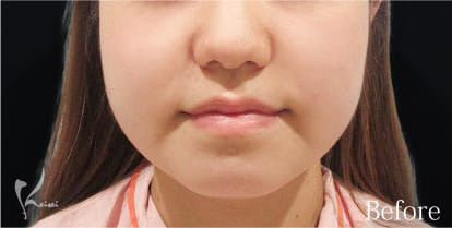 Before写真