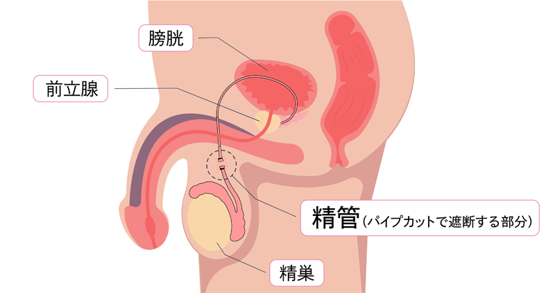 精管を遮断するパイプカットの仕組み