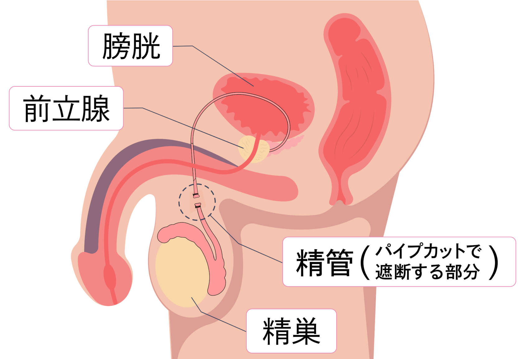 精管を遮断するパイプカットの手術についての解説