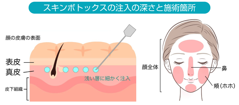 スキンボトックス