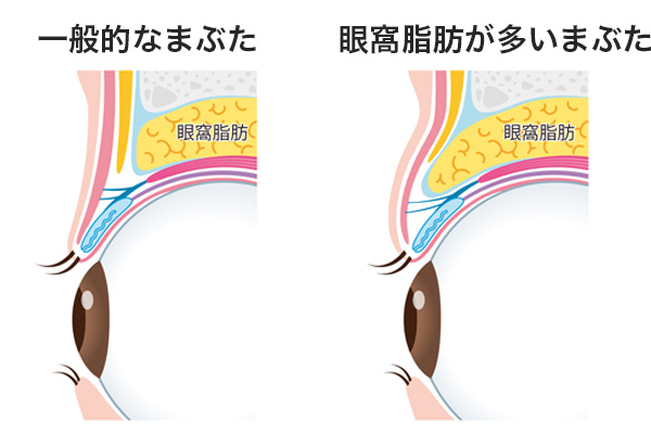 眼窩脂肪やたるみなど目の上がふくらむ原因