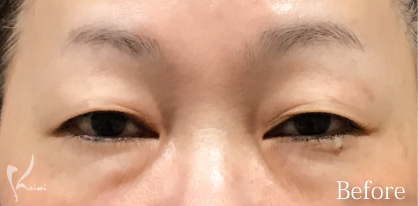 Before写真