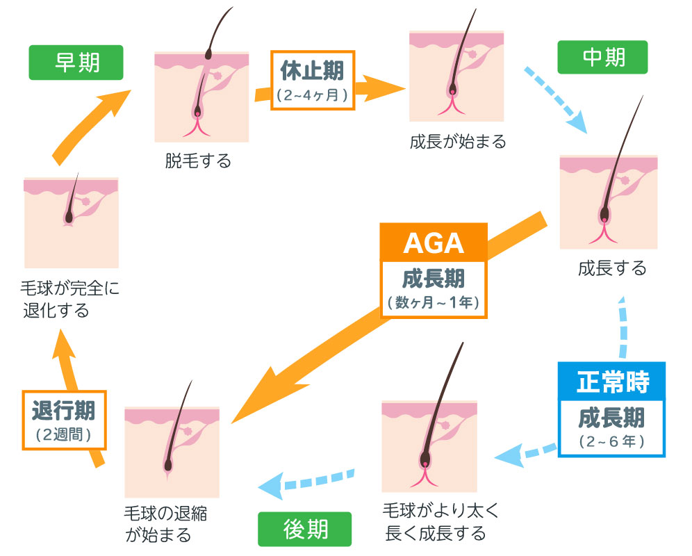 AGAの進行に関係する毛髪の成長サイクル