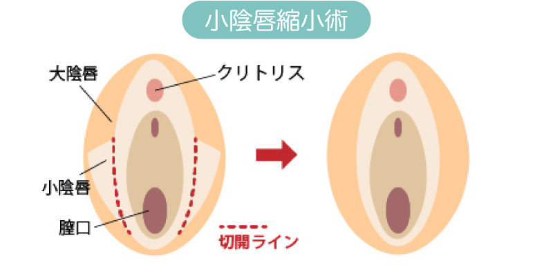 小陰唇縮小術