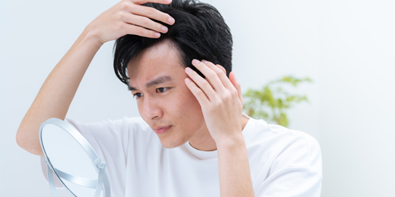 左右のこめかみ付近の生え際が後退したM字型の薄毛