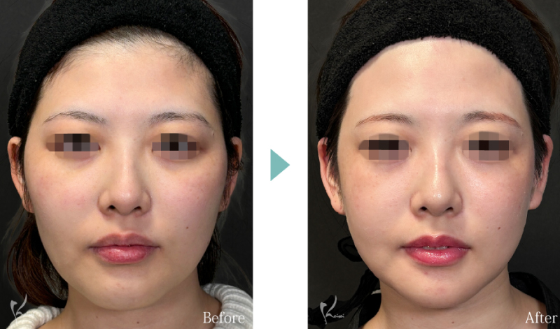 輪郭3点のBeforeとAfter