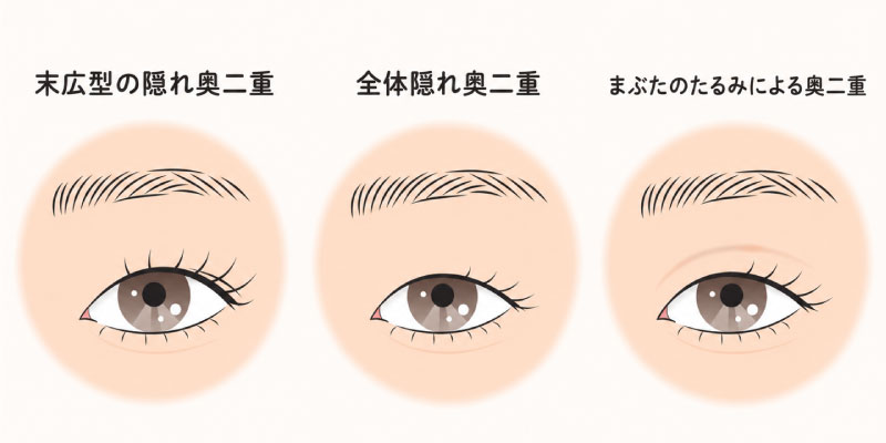 奥二重のイラストイメージ