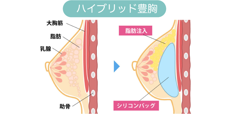 シリコンバッグと脂肪注入を組み合わせるハイブリッド豊胸の仕組み