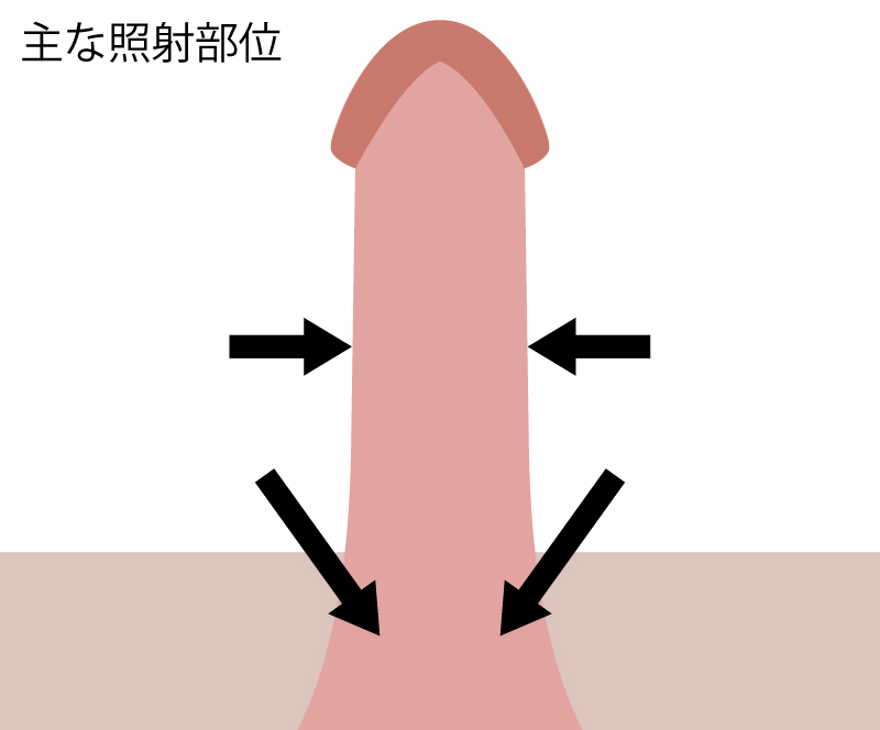 ED MAXの照射部位