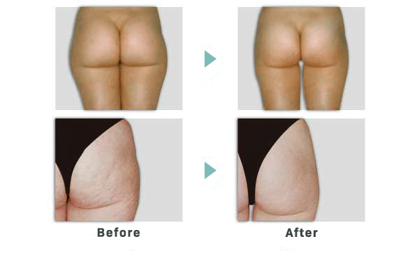 エンダモロジー ダイエット 痩身 メディカルダイエット 症例