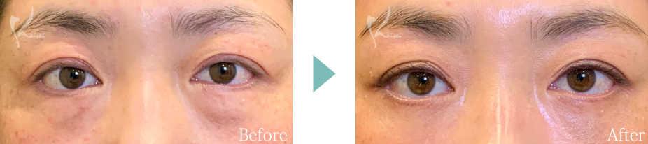 結膜側による目の下の脱脂法