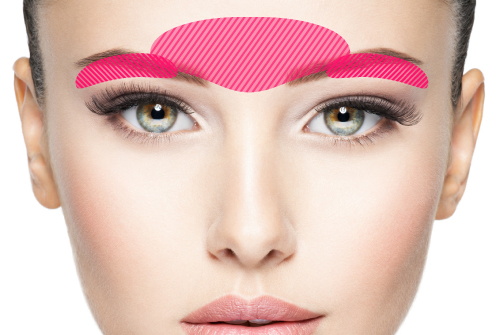 前額形成術（前頭骨の骨切り）