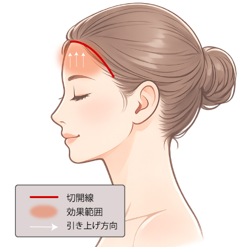 前額リフト（額縮小術）