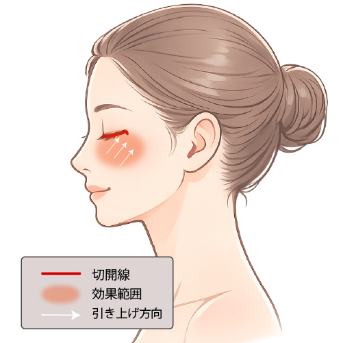 ミッドフェイスリフト イメージ
