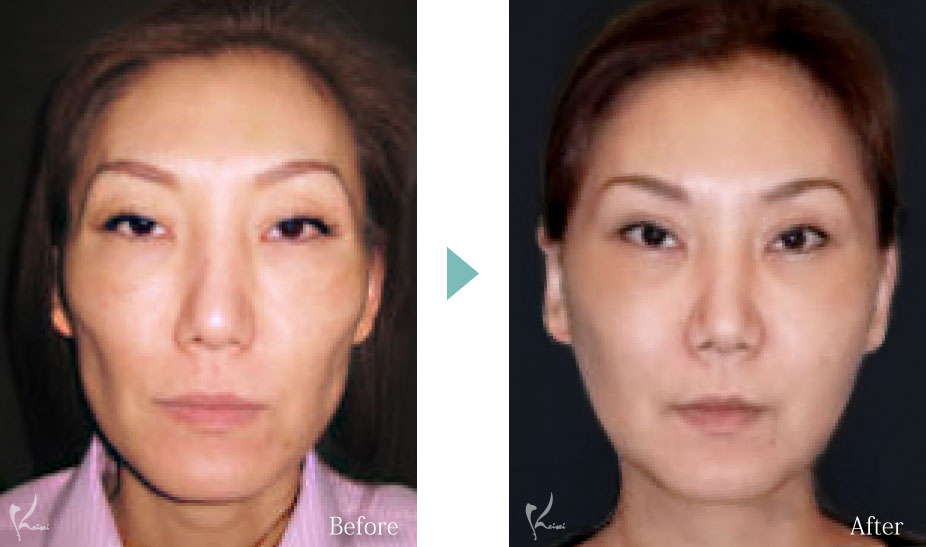 ホホ骨 頬骨 削り 骨削り フェイスライン 小顔 症例