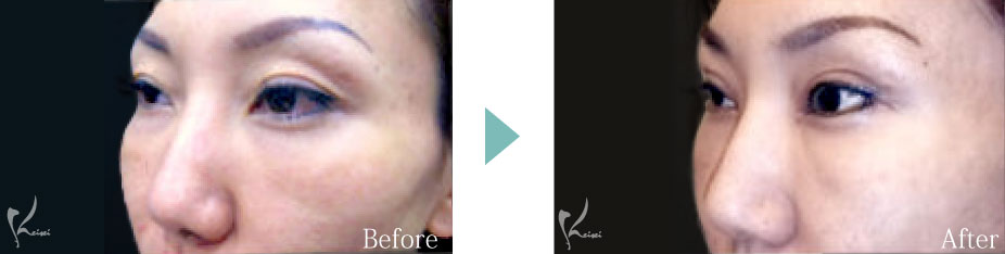 ホホ骨 頬骨 削り 骨削り フェイスライン 小顔 症例