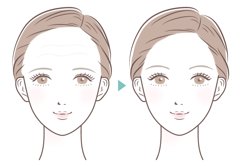 前額リフト（額短縮術）の効果イラスト（若者）