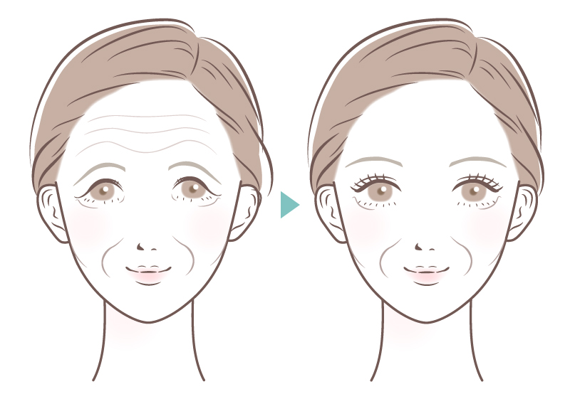 前額リフト（額短縮術）の効果イラスト（年配）