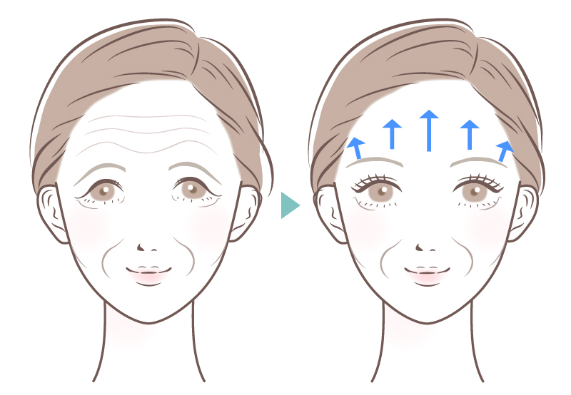 前額リフトイメージ