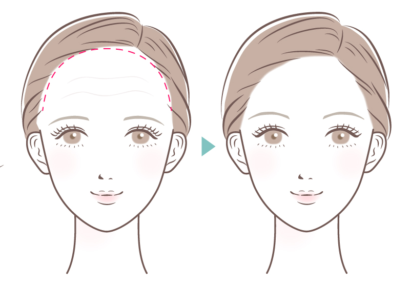 生え際切開法イメージ