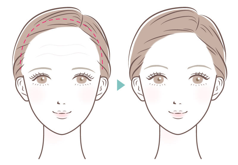 毛髪内切開法イメージ