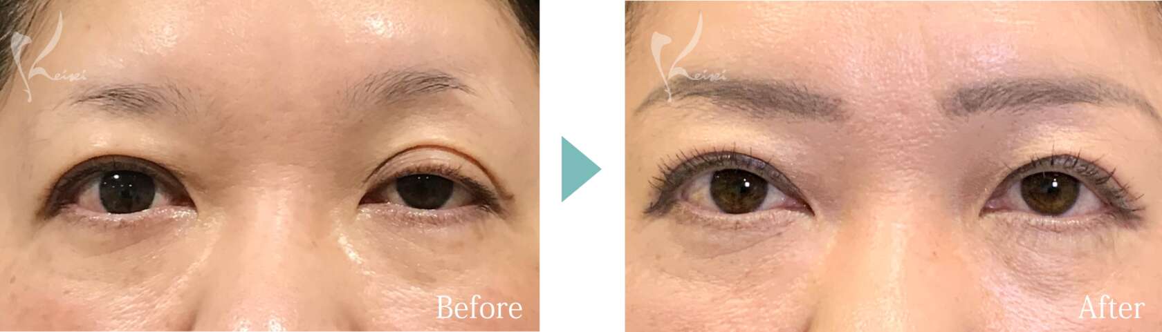 眼瞼下垂の症例写真