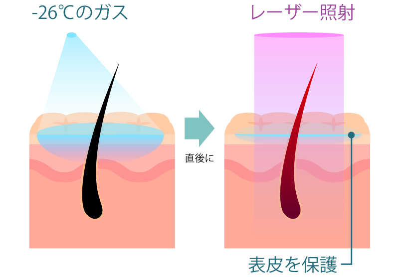 レーザー照射直前に寒剤をスプレー　画像