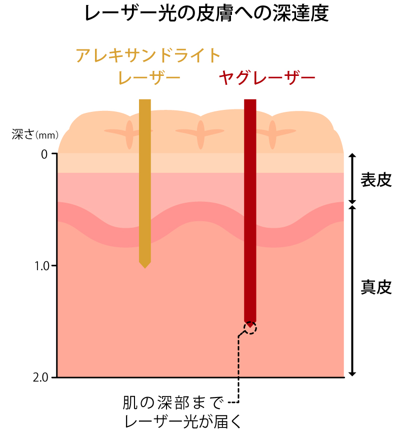 レーザー光の皮膚への深達度