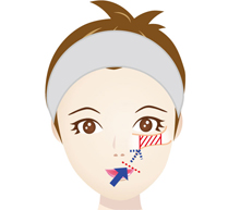 ホホ骨 頬骨 削り 骨削り フェイスライン 小顔　頬骨骨切り（頬骨形成術）