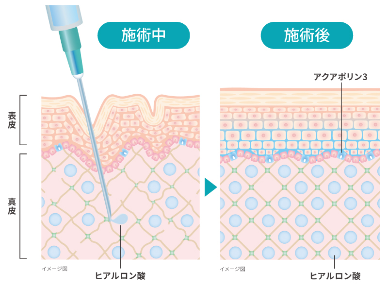 スキンバイブ施術後イメージ