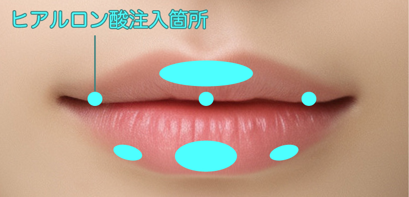ヒアルロン酸の注入箇所