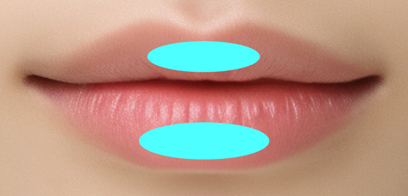 ボリュームアップの注入箇所