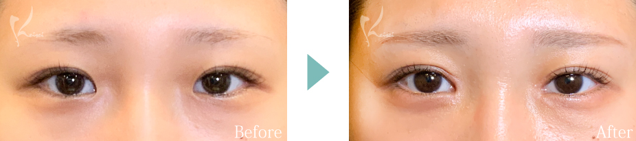 目頭切開の症例写真