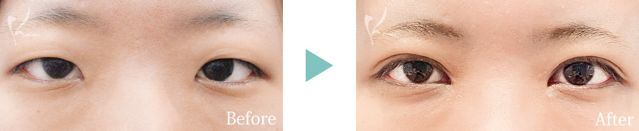 目頭切開＋MT埋没法の症例写真