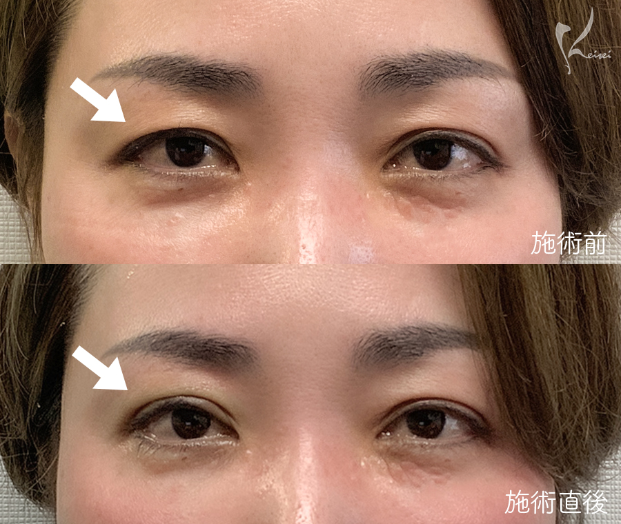 右目埋没の小西先生ビフォーアフター