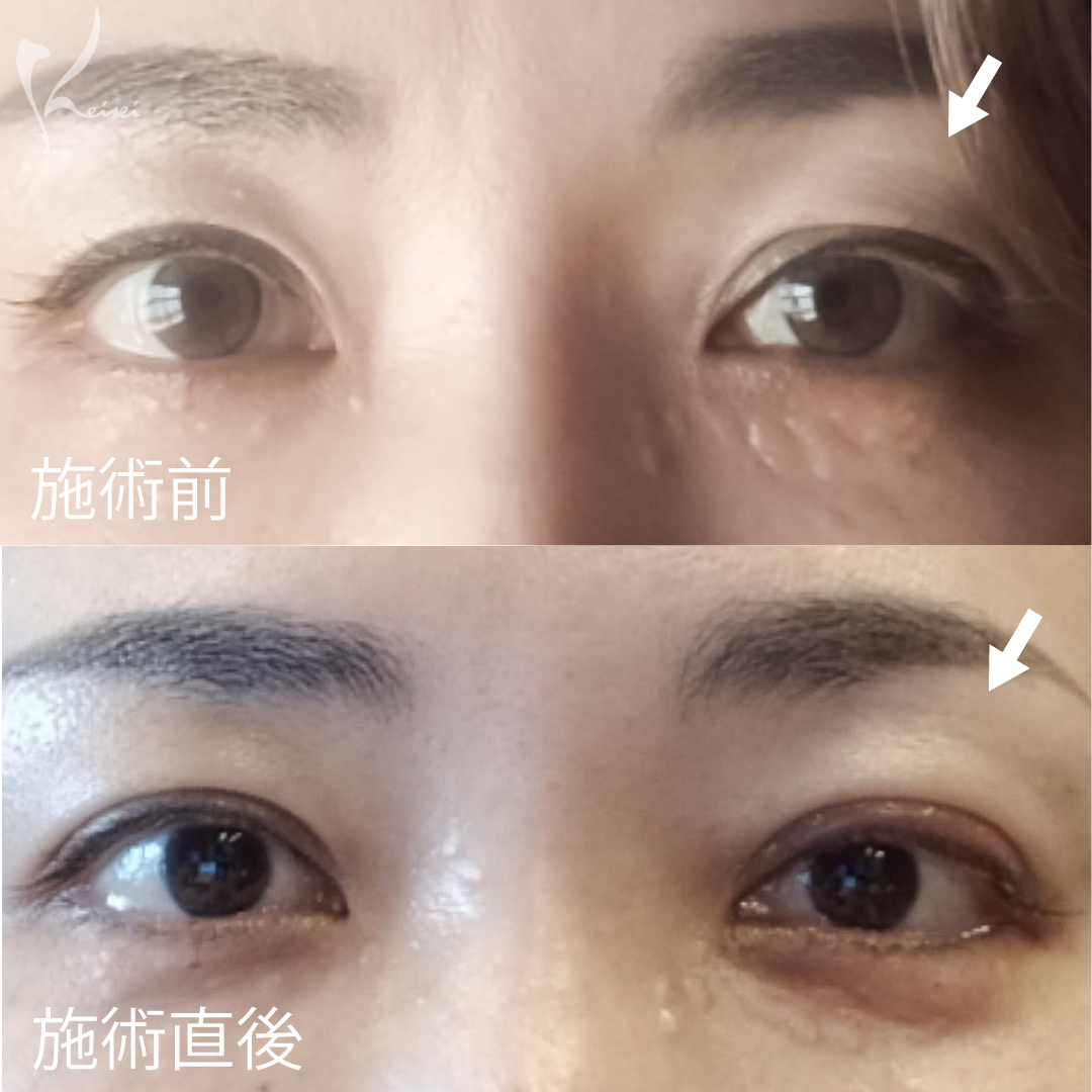 左目埋没後の小西先生ビフォーアフター