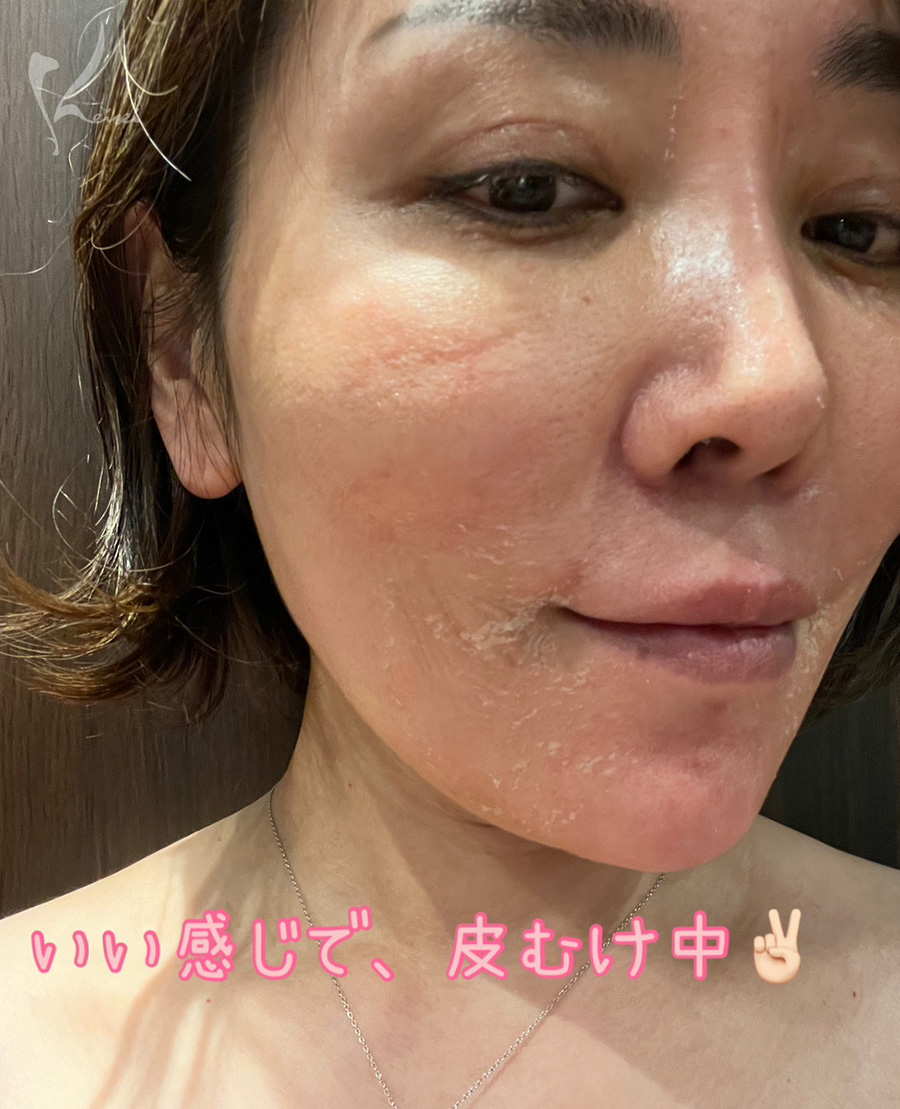 セラピューティック使用中の皮剥けの様子