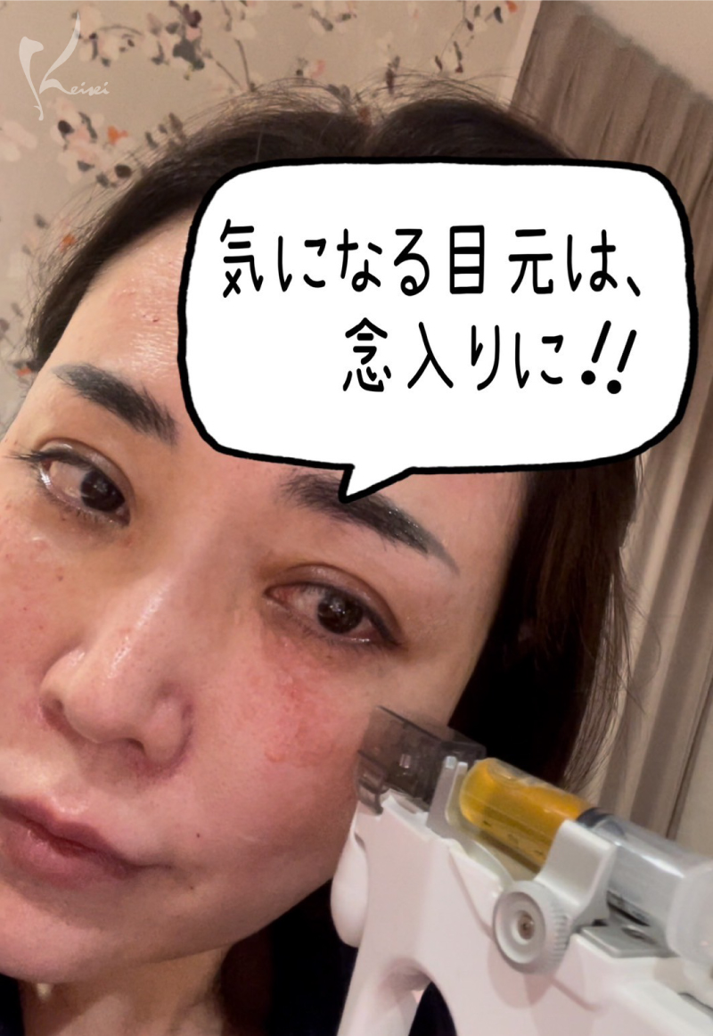 PRP水光注射の小西医師の施術写真