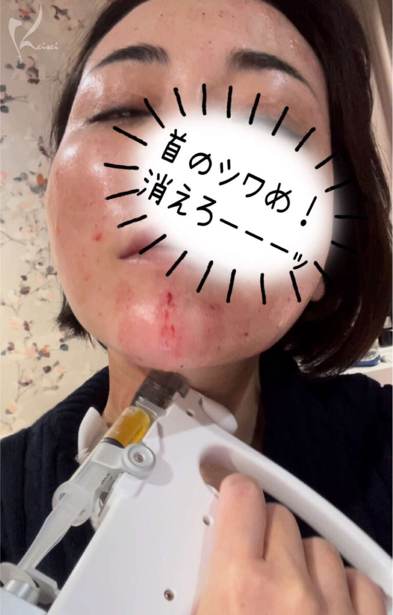 PRP水光注射の首小西医師の施術写真