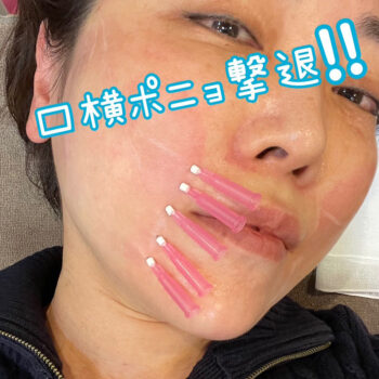 ウルトラVリフト（ショッピングスレッド）を受ける小西医師