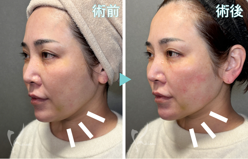 ソフウェーブ効果　ビフォーアフター