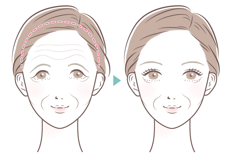 フェイスリフト 輪郭 たるみ リフトアップ エイジングケア アンチエイジング フォアヘッドリフト