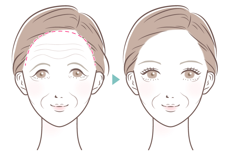 フェイスリフト 輪郭 たるみ リフトアップ エイジングケア アンチエイジング