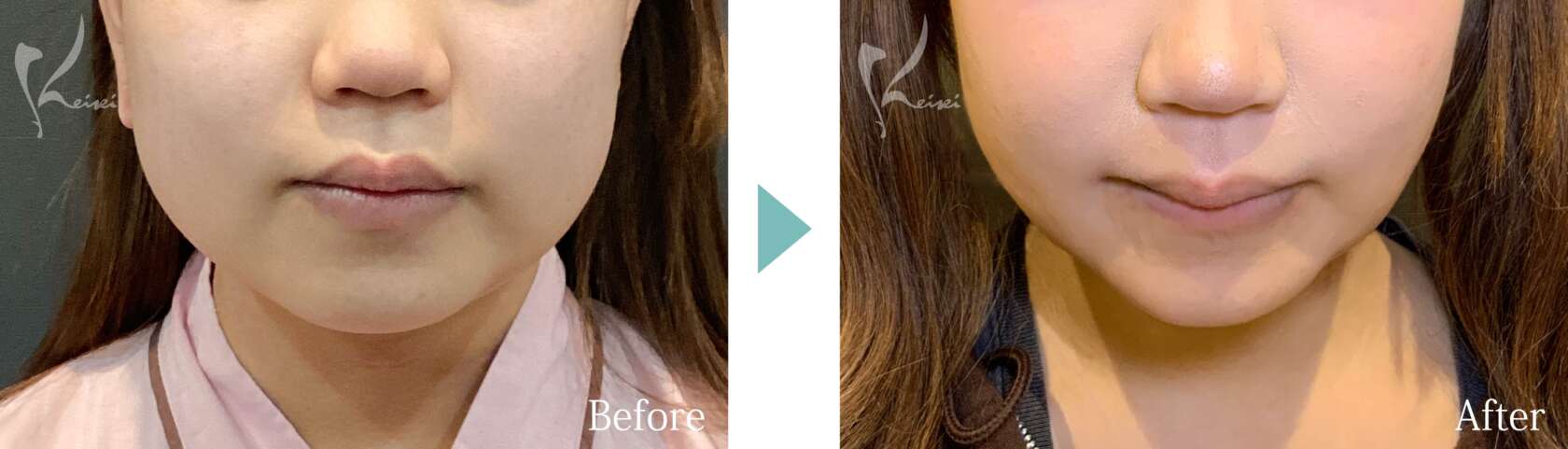 ホホ・アゴの脂肪吸引＋バッカルファット除去の症例