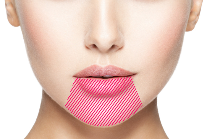 下顎セットバック　下顎分節骨切術（下顎前突治療）