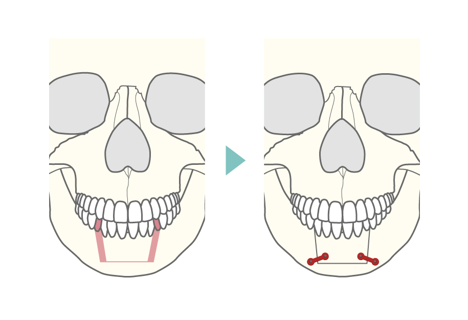 下顎セットバック（下顎分節骨切り術（抜歯あり））の正面からのイメージ