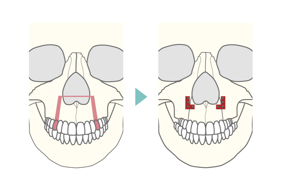 上顎セットバック（上顎分節骨切術（抜歯あり））術式の正面からのイメージ